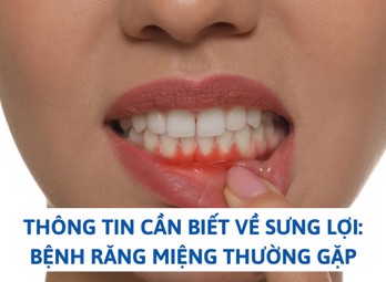 Thông tin cần biết về sưng lợi: Bệnh răng miệng thường gặp